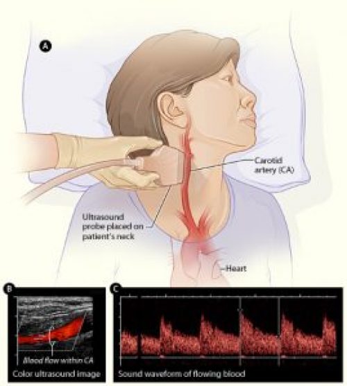 carotid_ultrasound-269x300